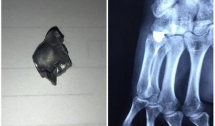 Ovo je metak koji je izvađen iz šake srpskog mladića: Objavljen i rendgenski snimak