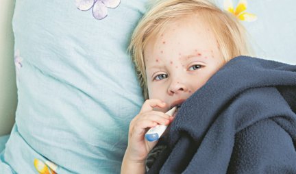 Oprez! Zarazna bolest širi se među najmlađima - Varičele usred leta ispraznile vrtiće!