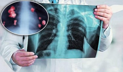 Poražavajući podatak: Trećina obolelih od raka pluća i dalje puši!