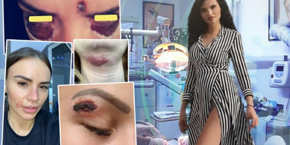 ŠOKANTNO! Istražili smo priču o OLGICI, hit-doktorki sa Instagrama, čiji tretmani ženama ostavljaju UŽASNE OPEKOTINE NA LICU!